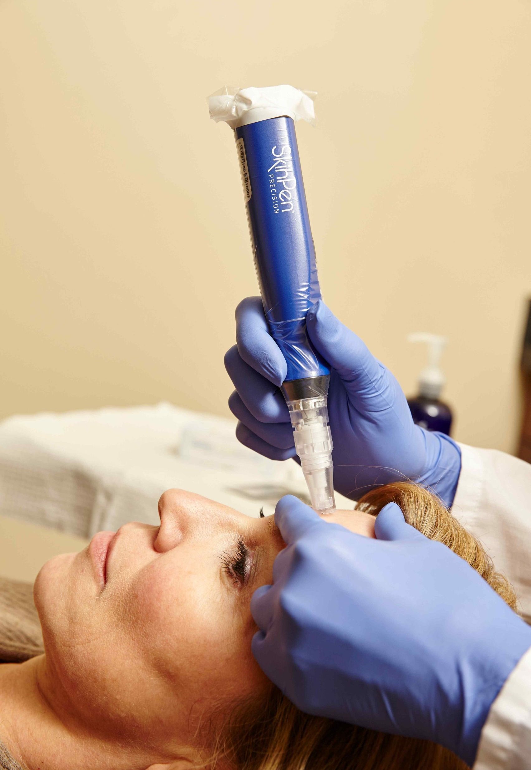 SkinPen en Medellín: tratamiento para cicatrices de acné, poros y textura irregular