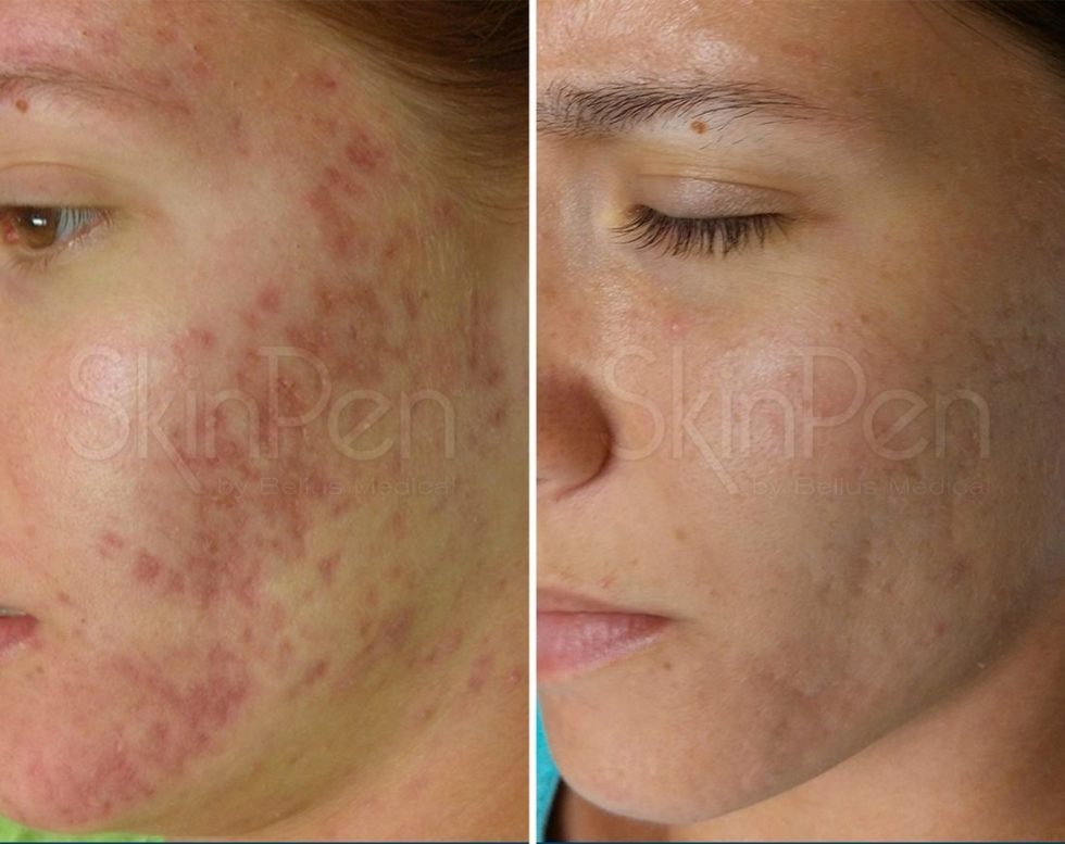 imgi_83_SkinPen_Acne_Melbourne_Female_NA_Before-and-After-Picture_x1200-940x1024-1-980x1067