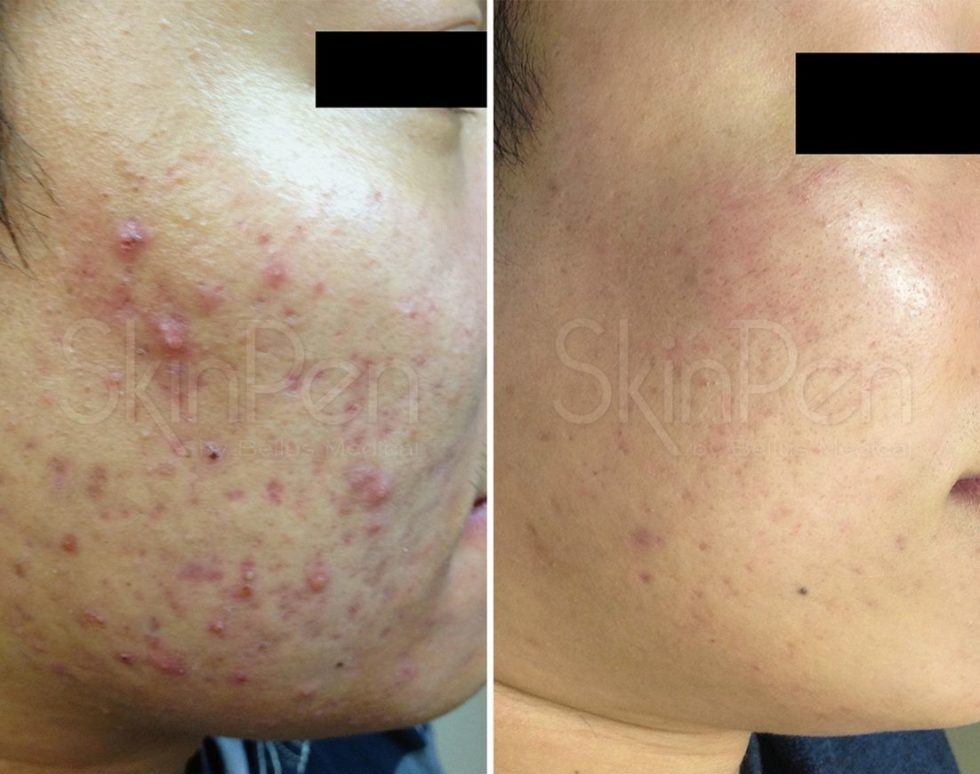 imgi_85_SkinPen_Acne_Orange_Male_27_Before-and-After-Picture_x1200-940x1024-1-980x1067