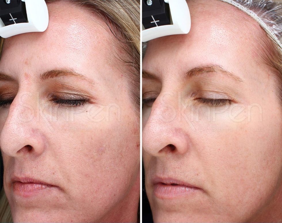 imgi_87_SkinPen_Wrinkles_Orange_Female_45_Before-and-After-Picture_x1200-940x1024-1-980x1067