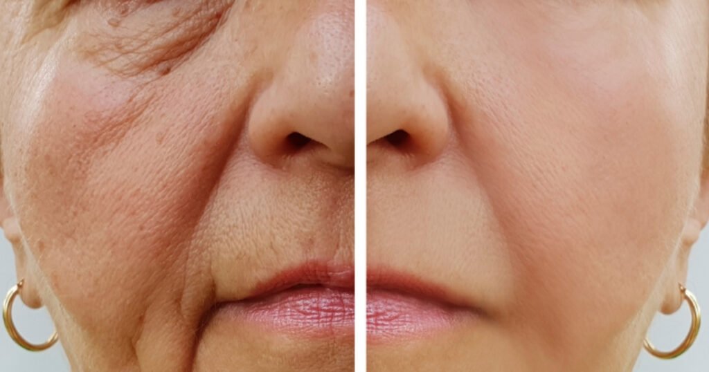 Todo sobre flacidez facial en Medellín