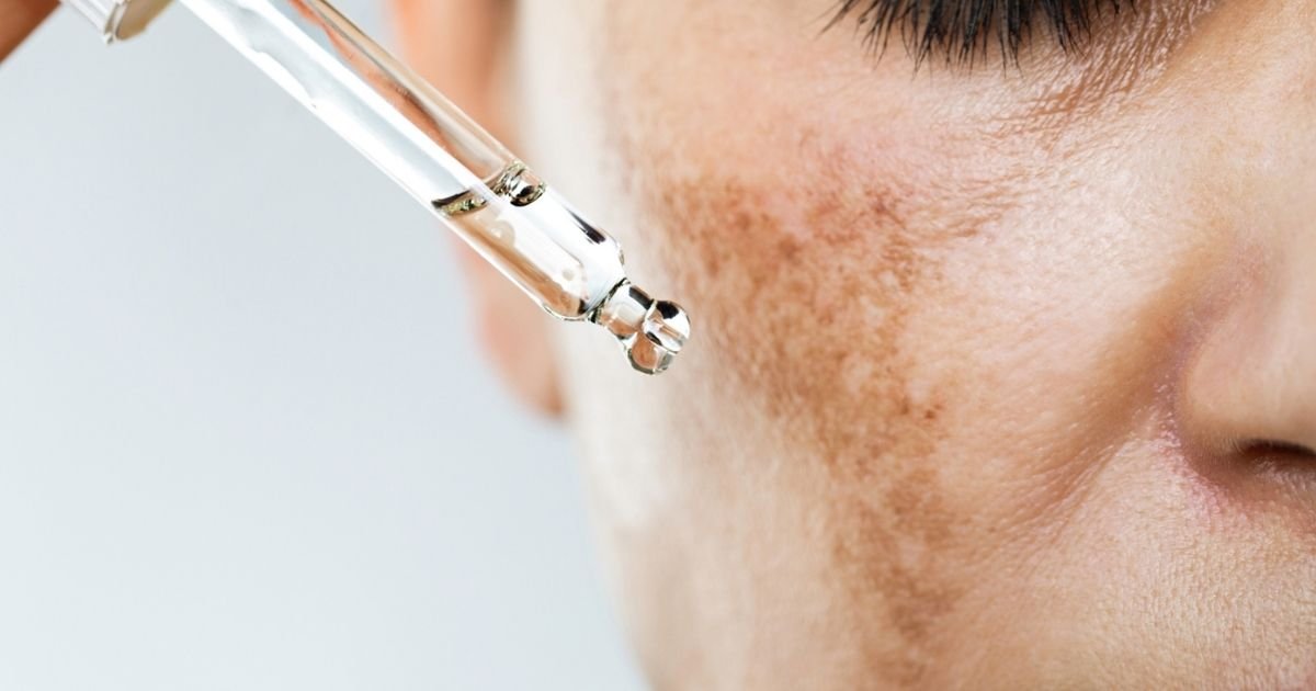 Todo sobre melasma en Medellín
